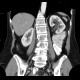 Hydronephrosis, grade I, bilateral, initial: CT - Computed tomography
